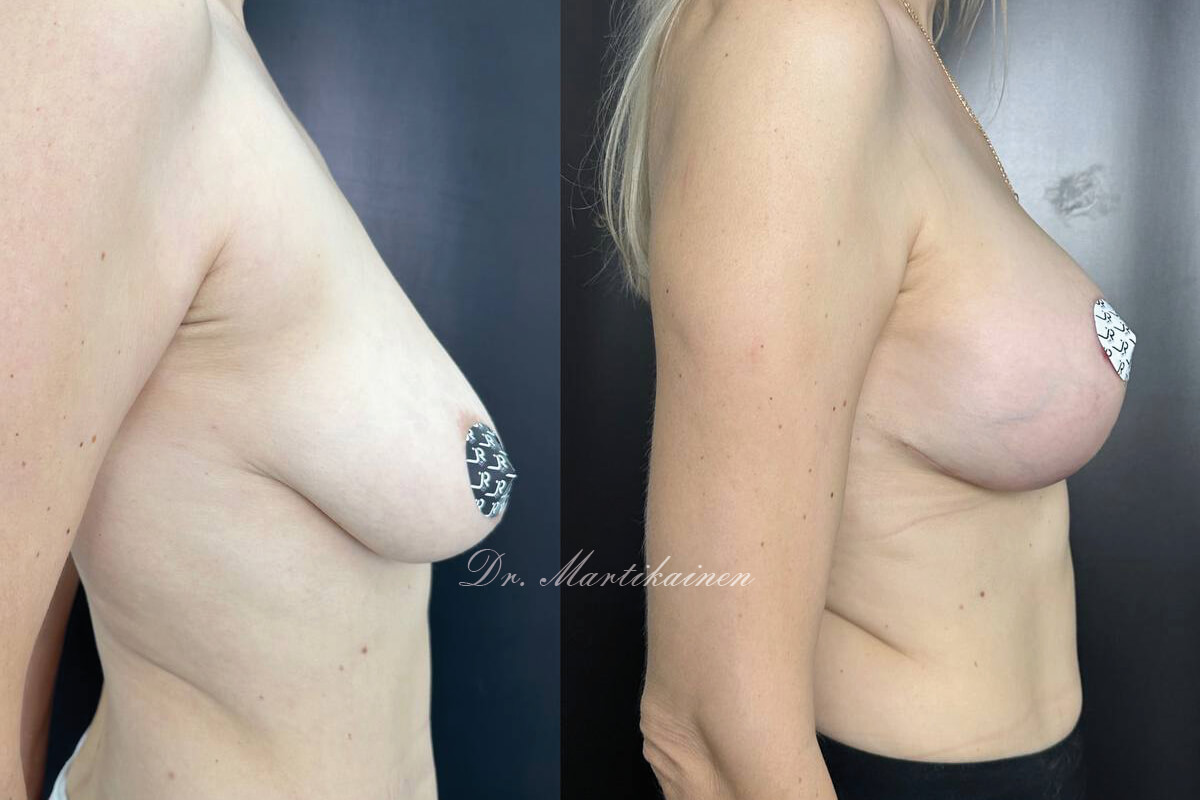 Подтяжка груди (мастопексия) 01