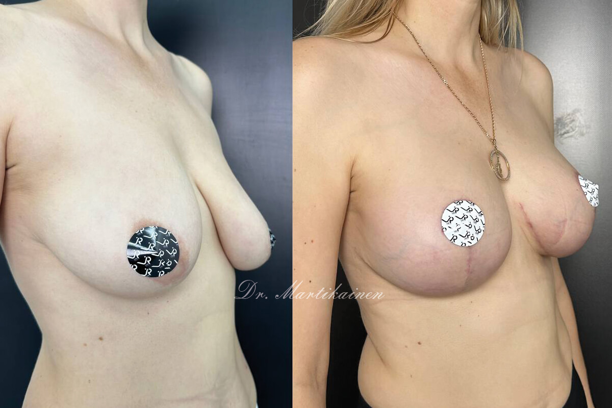 Подтяжка груди (мастопексия) 01