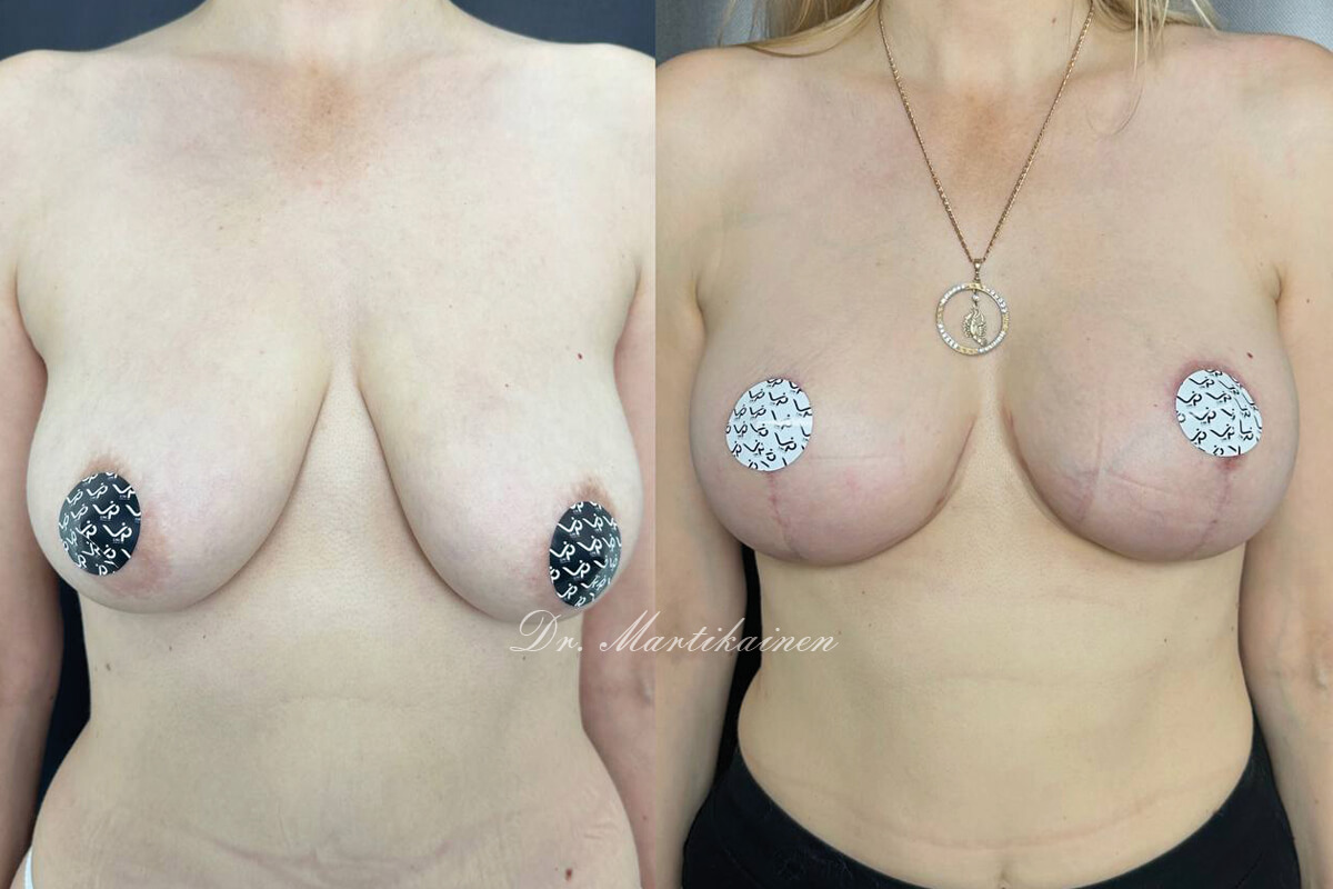 Увеличение груди имплантами 01