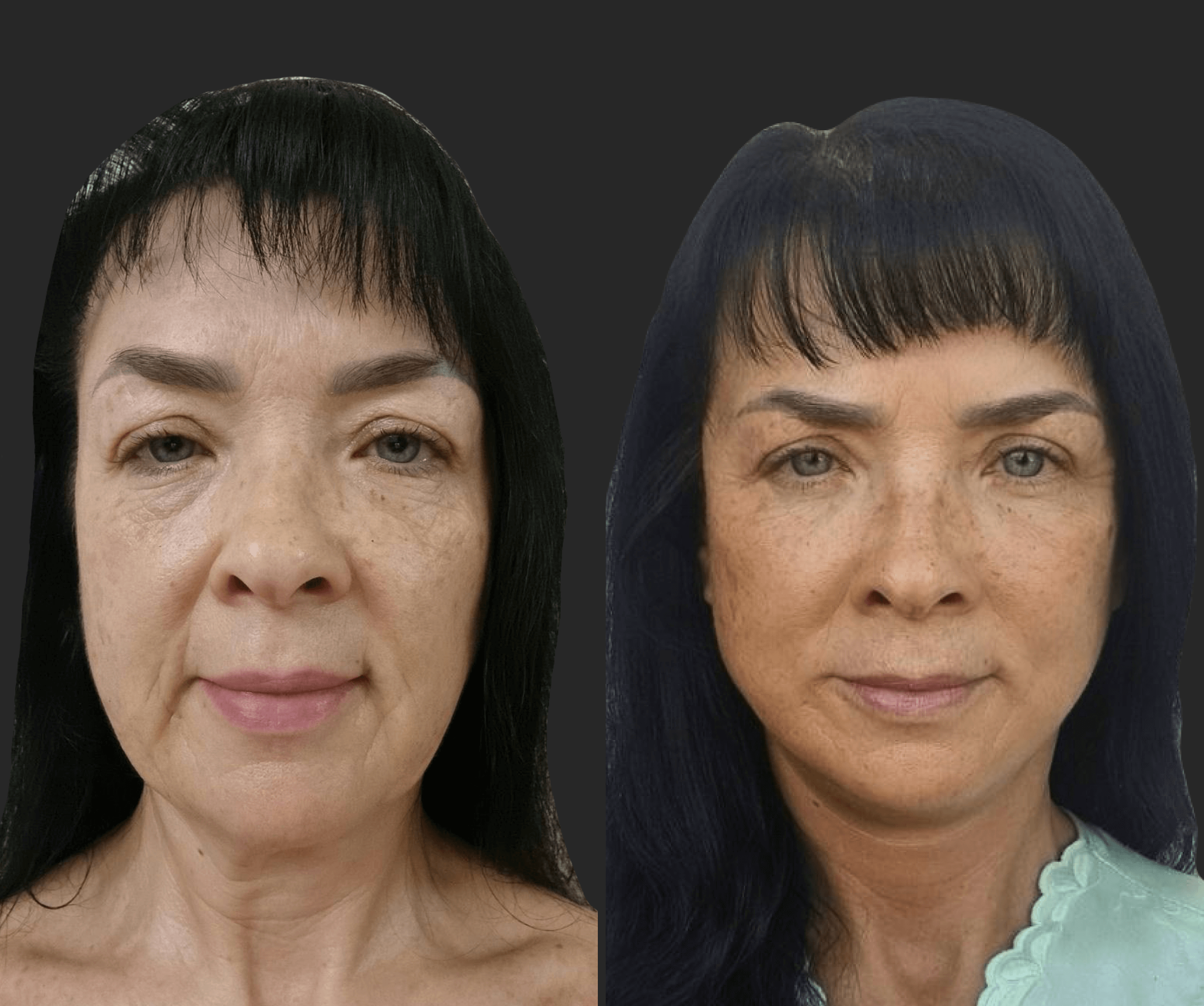 Нижняя блефаропластика 01