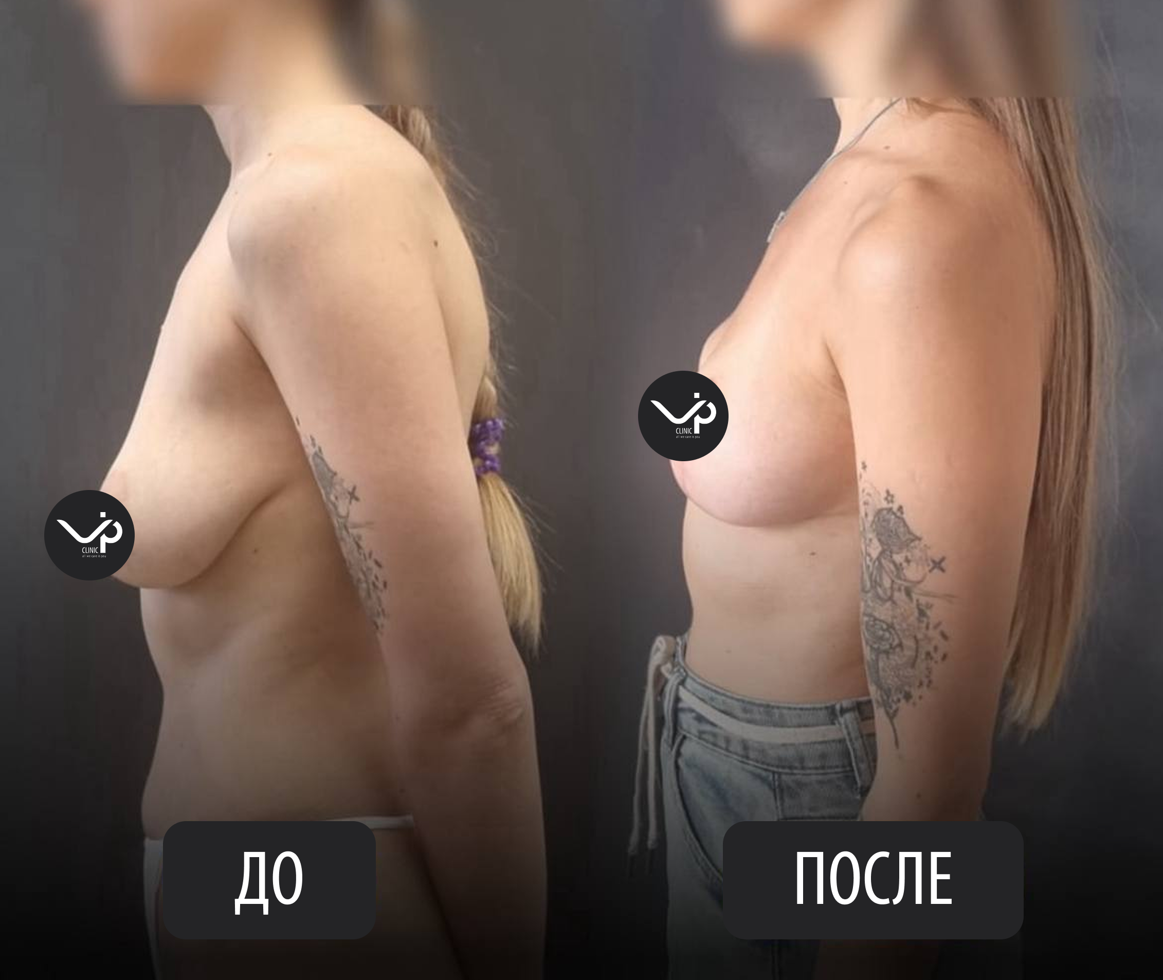 Подтяжка груди (мастопексия) 01