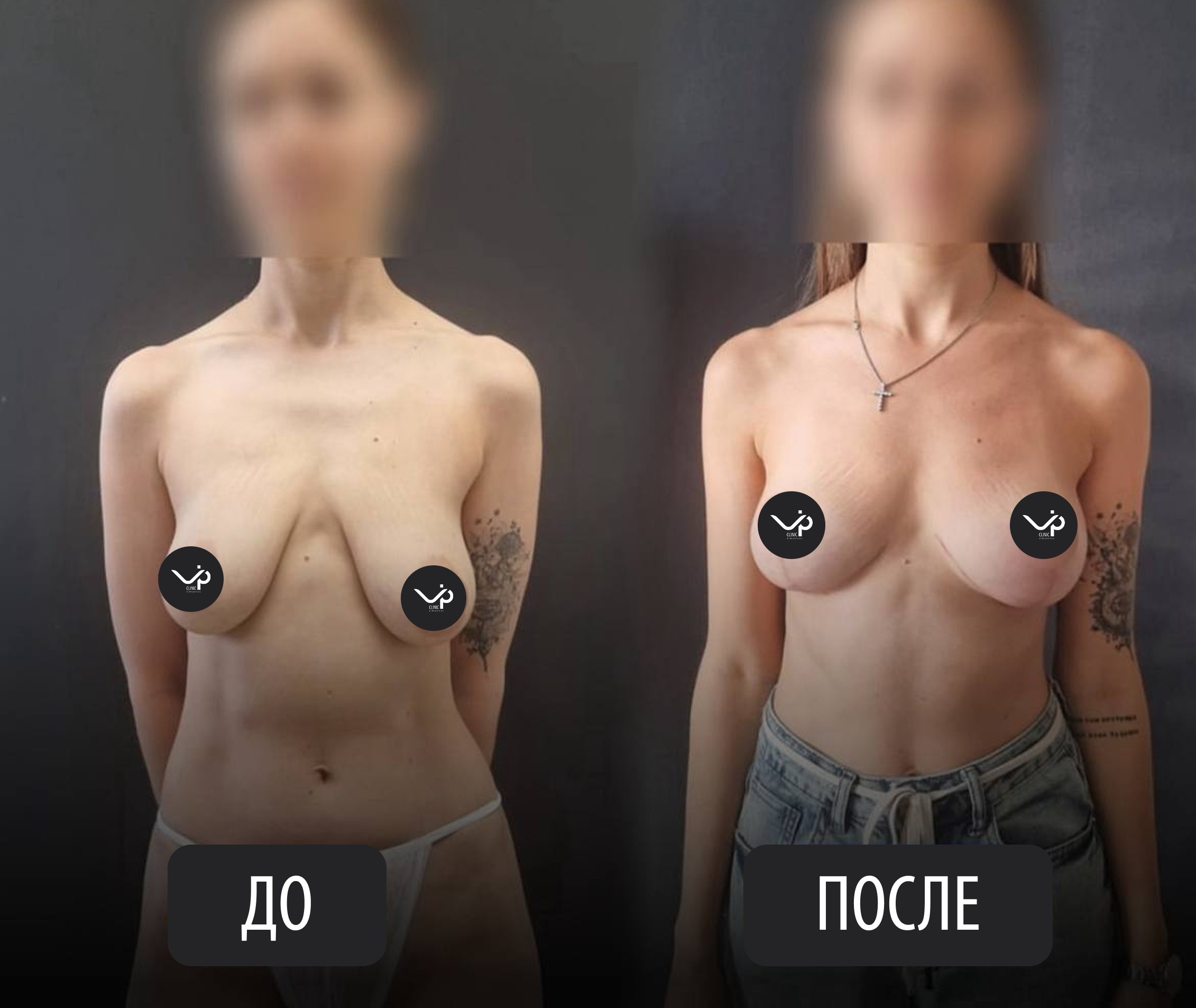 Подтяжка груди (мастопексия) 01