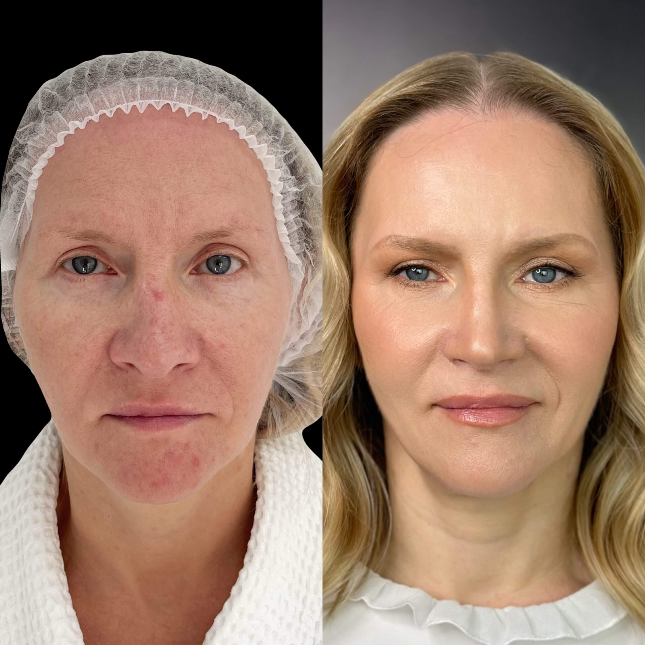 Ринопластика 01