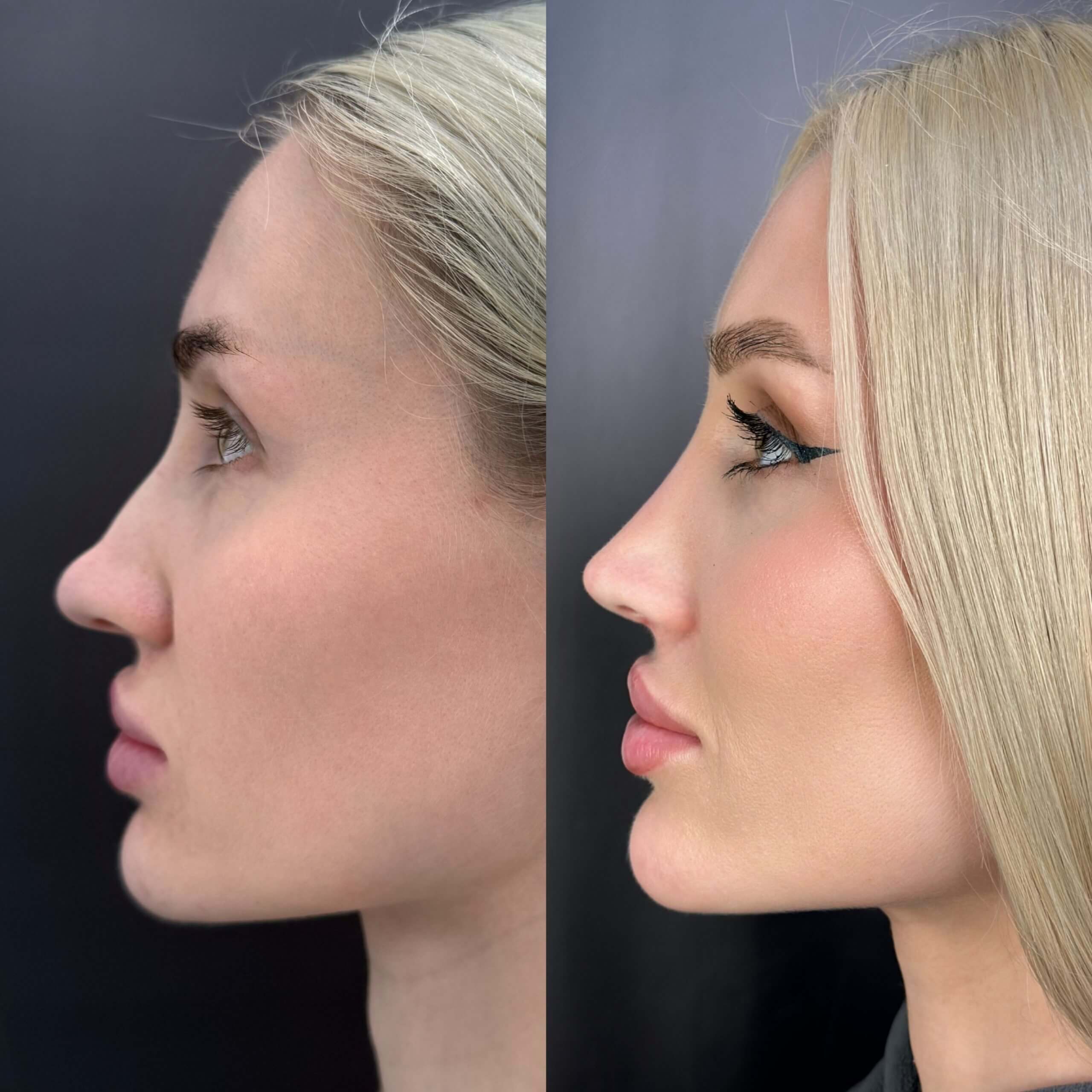 Ринопластика 01