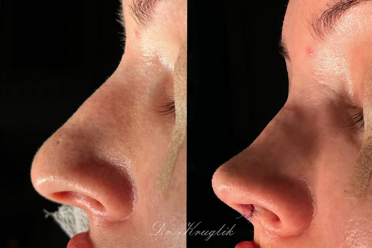 Ринопластика 01