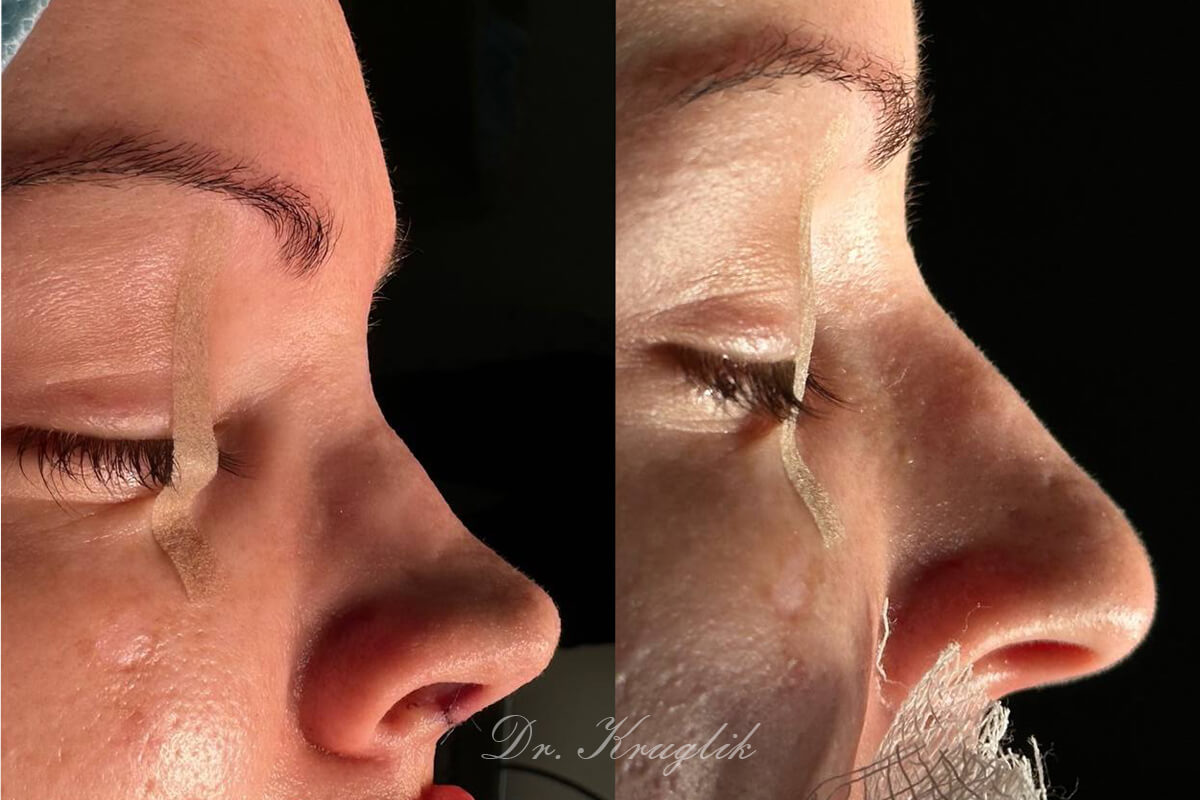 Ринопластика 01