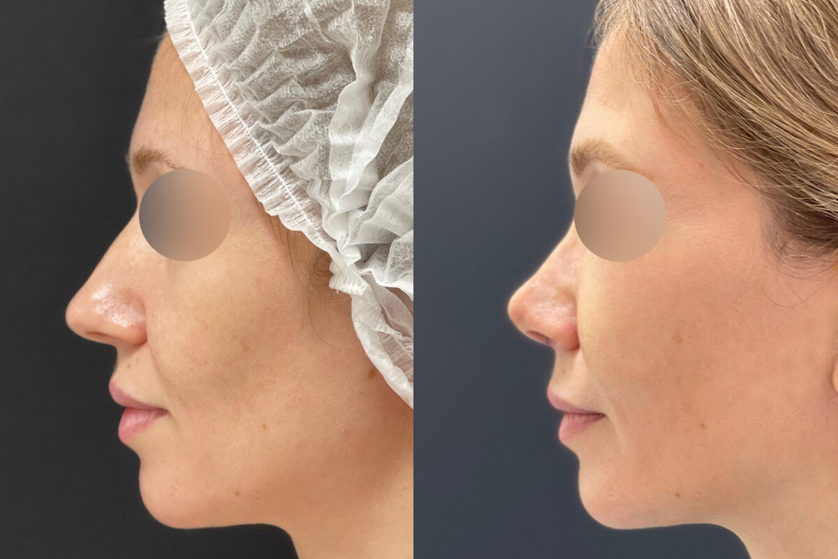 Ринопластика 01