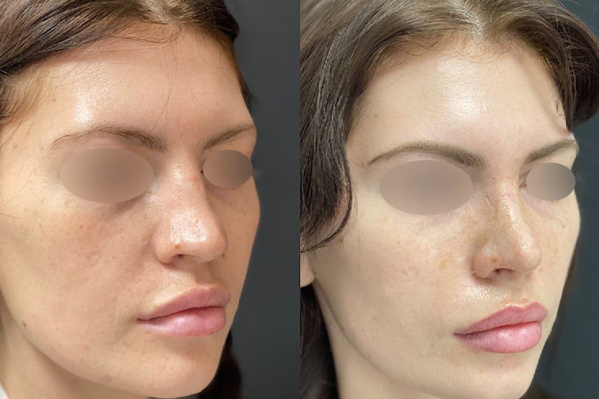 Ринопластика 01