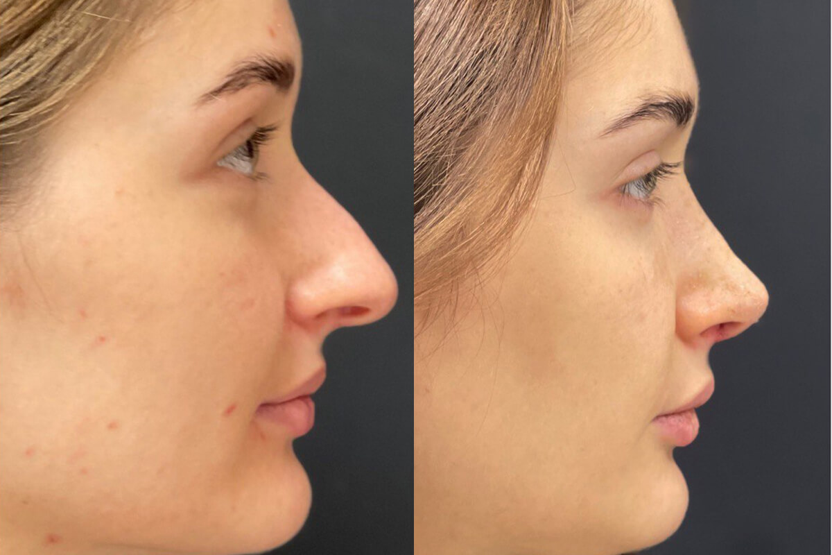 Ринопластика 01