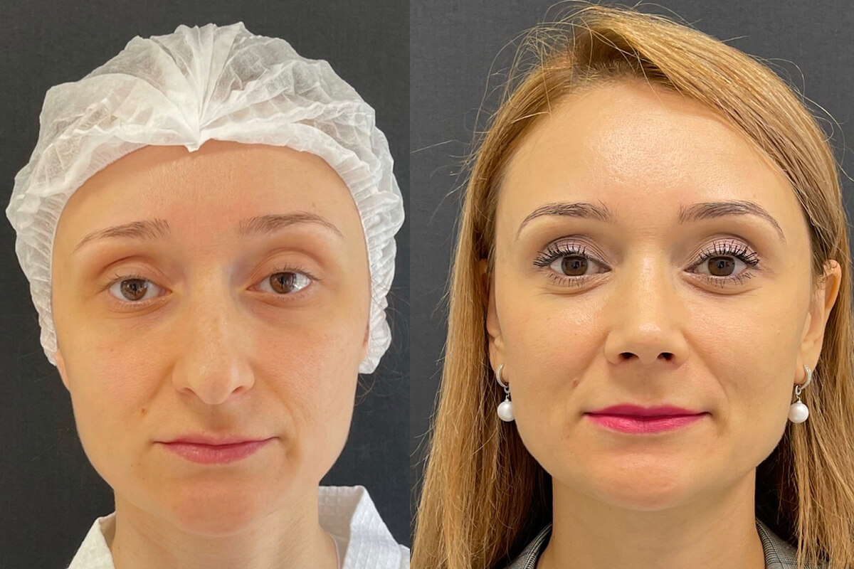 Ринопластика 01