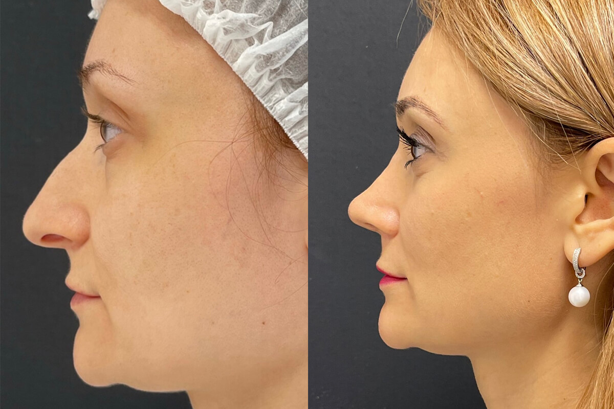 Ринопластика 01