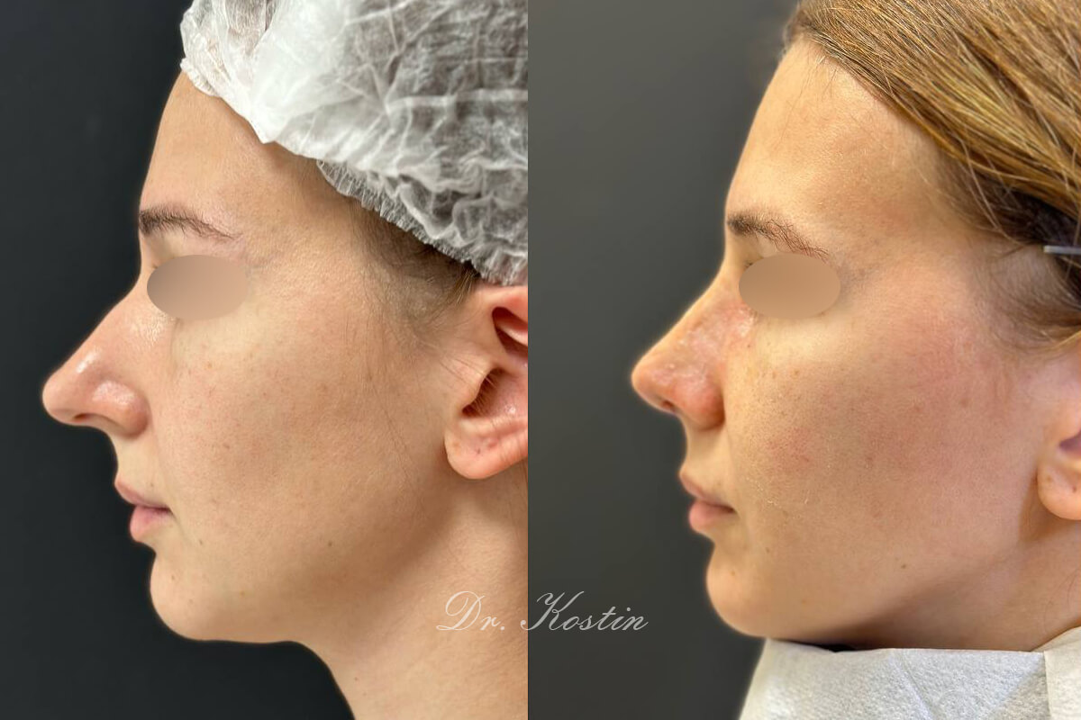 Ринопластика 01