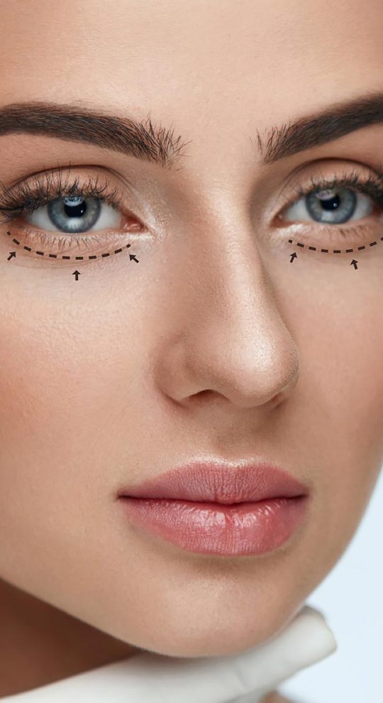 Нижняя блефаропластика