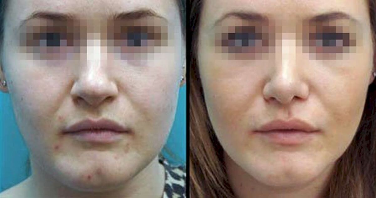 Удаление комков Биша 01