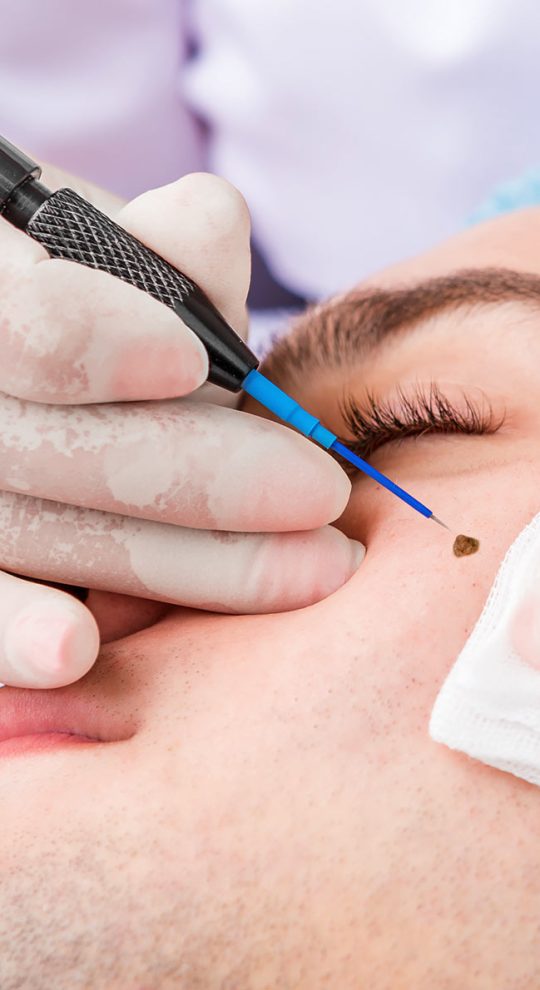 Удаление новообразований