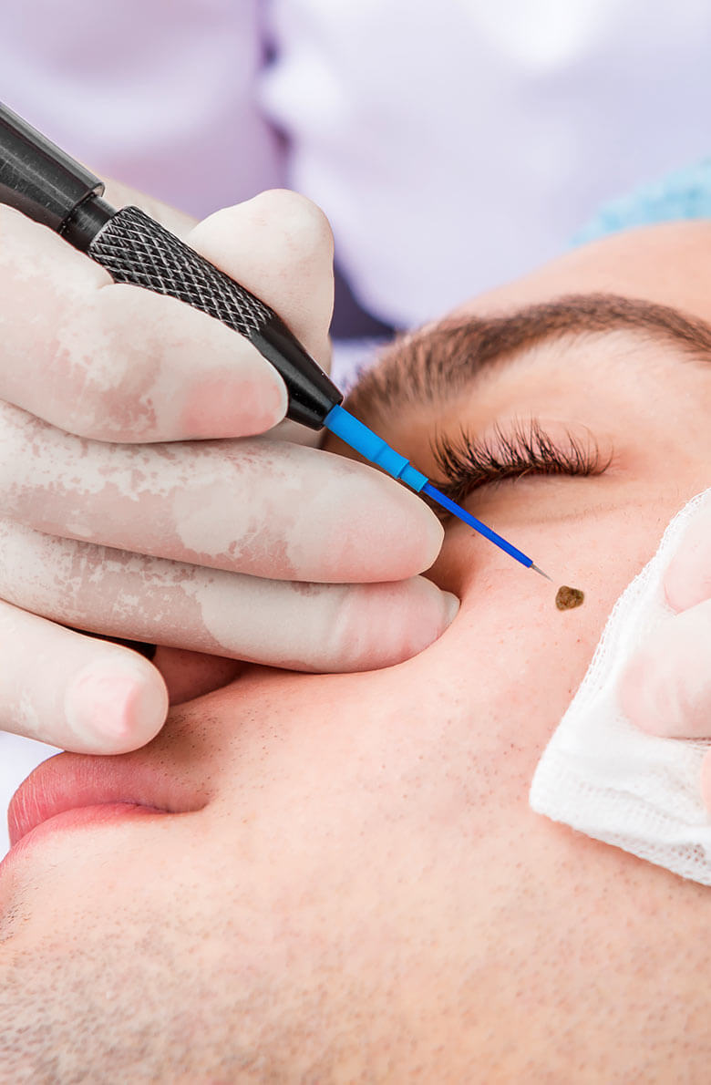 Удаление новообразований