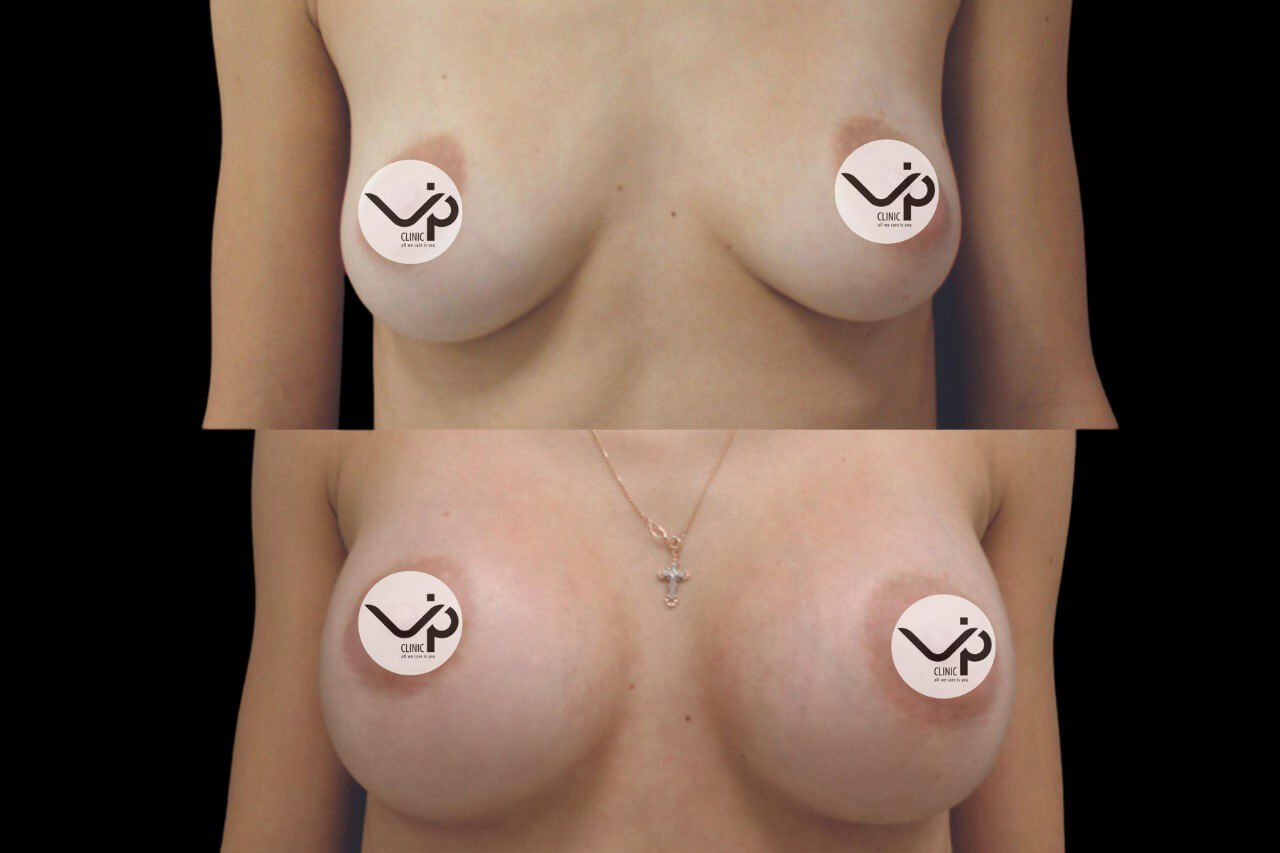Увеличение груди имплантами 01