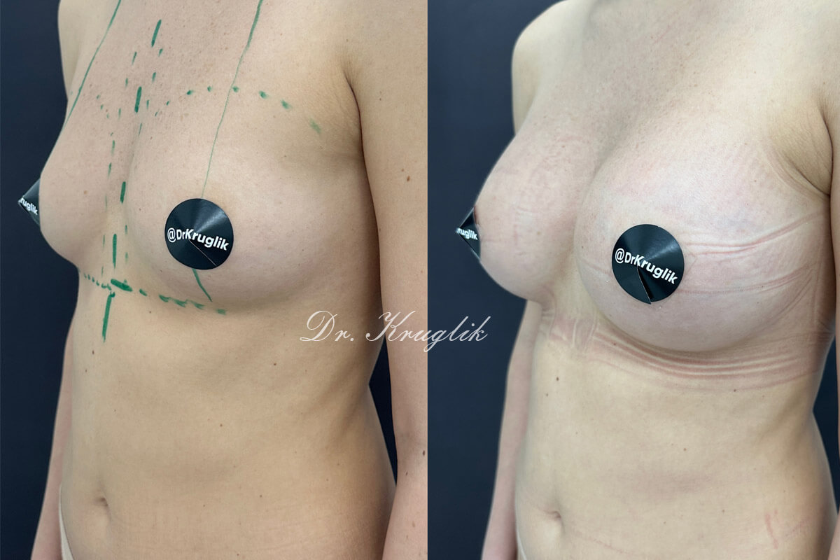 Увеличение груди имплантами 01