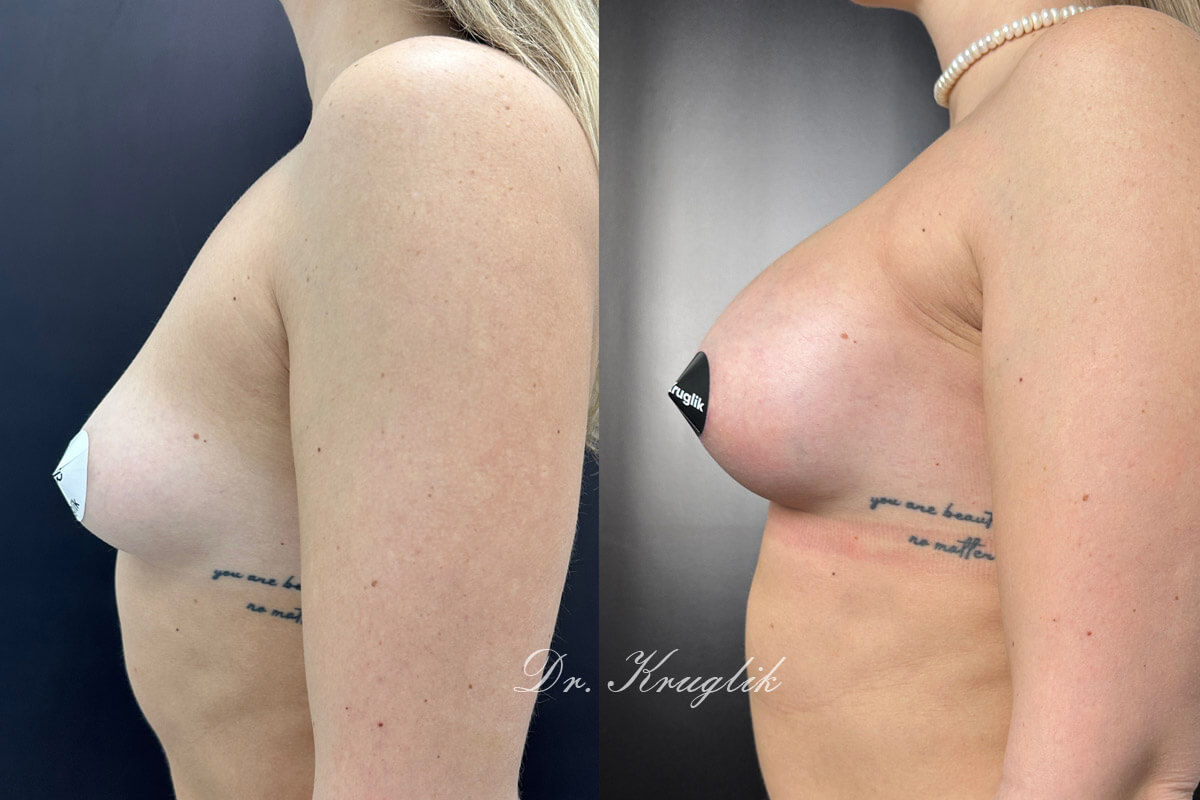 Увеличение груди имплантами 01