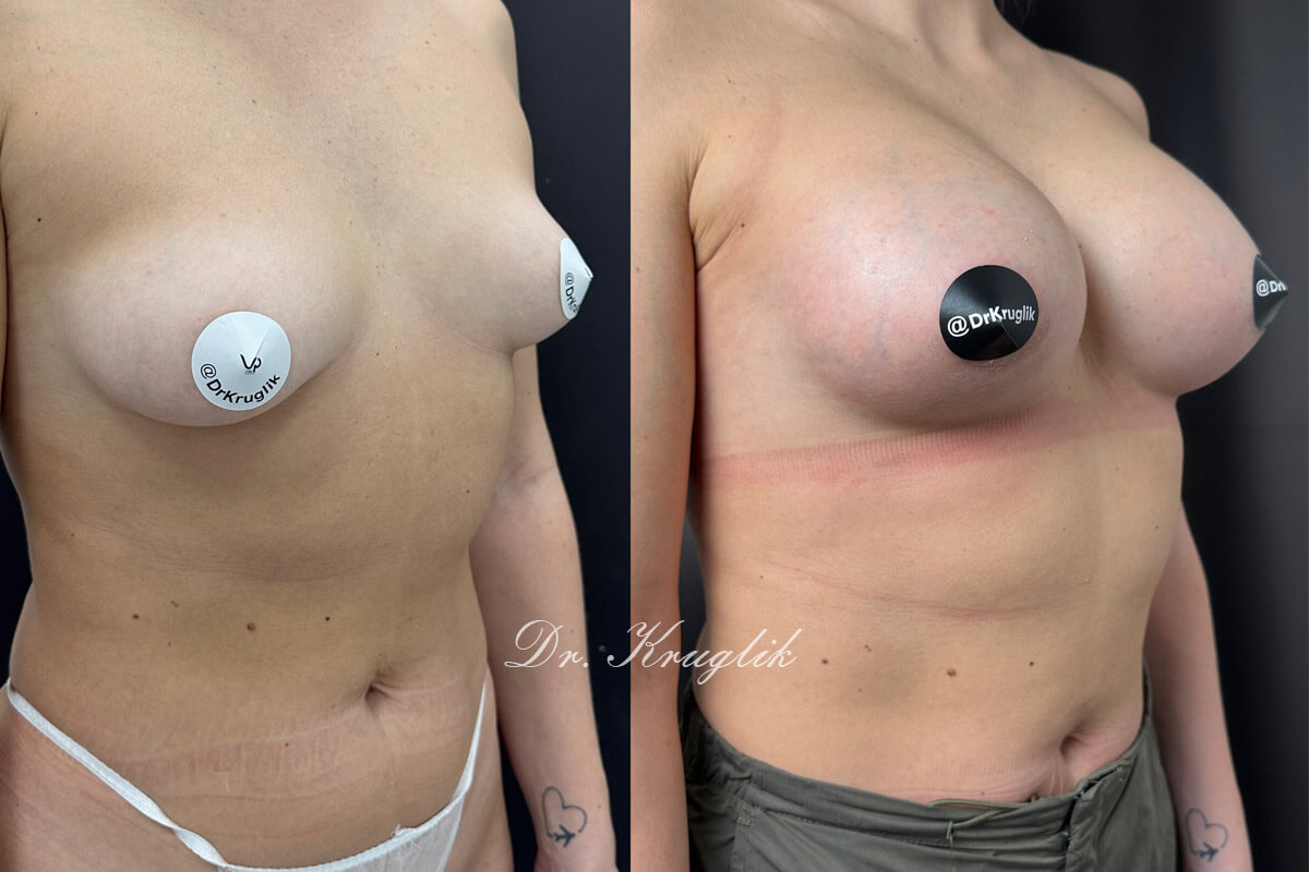 Увеличение груди имплантами 01