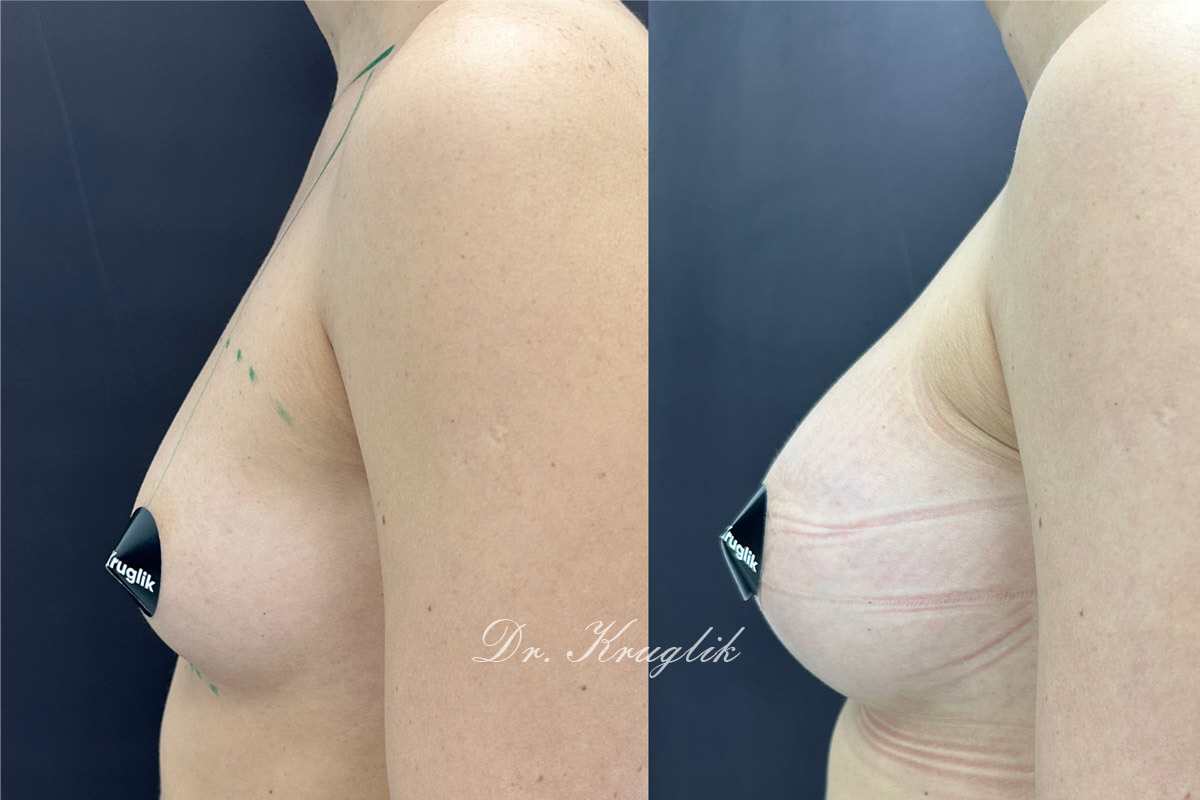 Увеличение груди имплантами 01