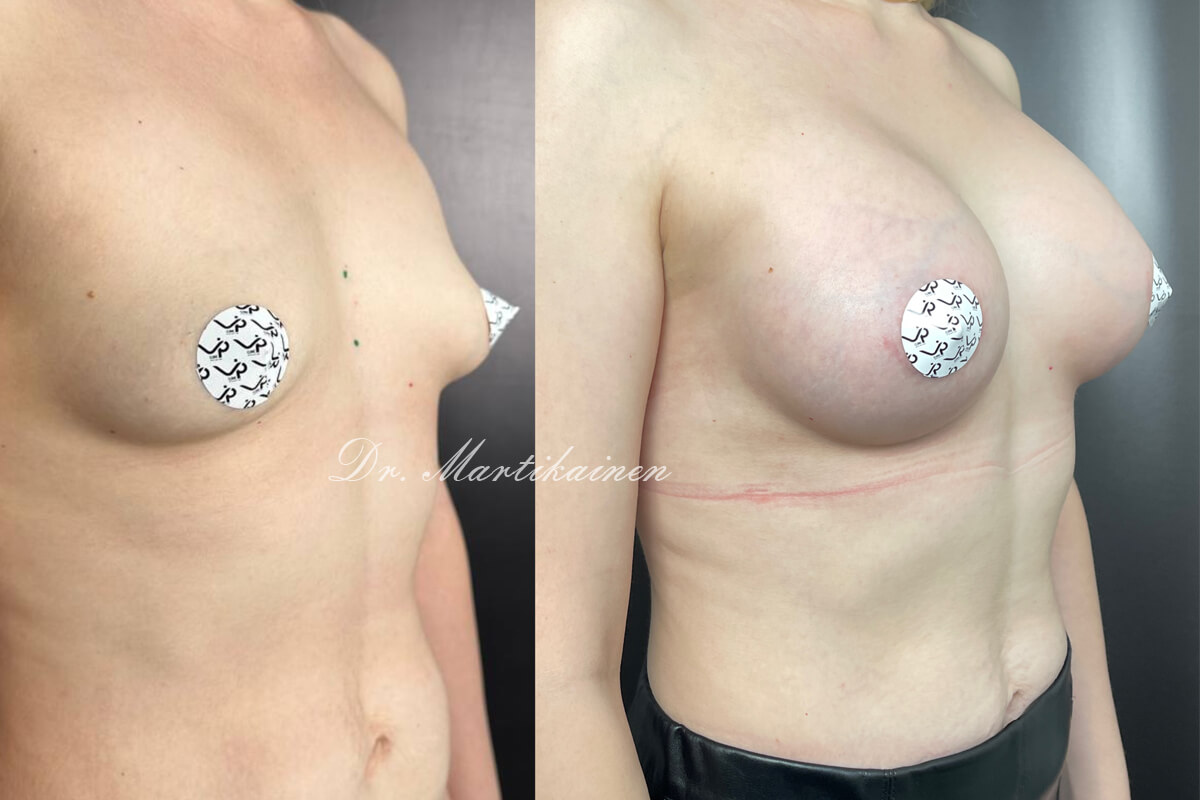 Увеличение груди имплантами 01