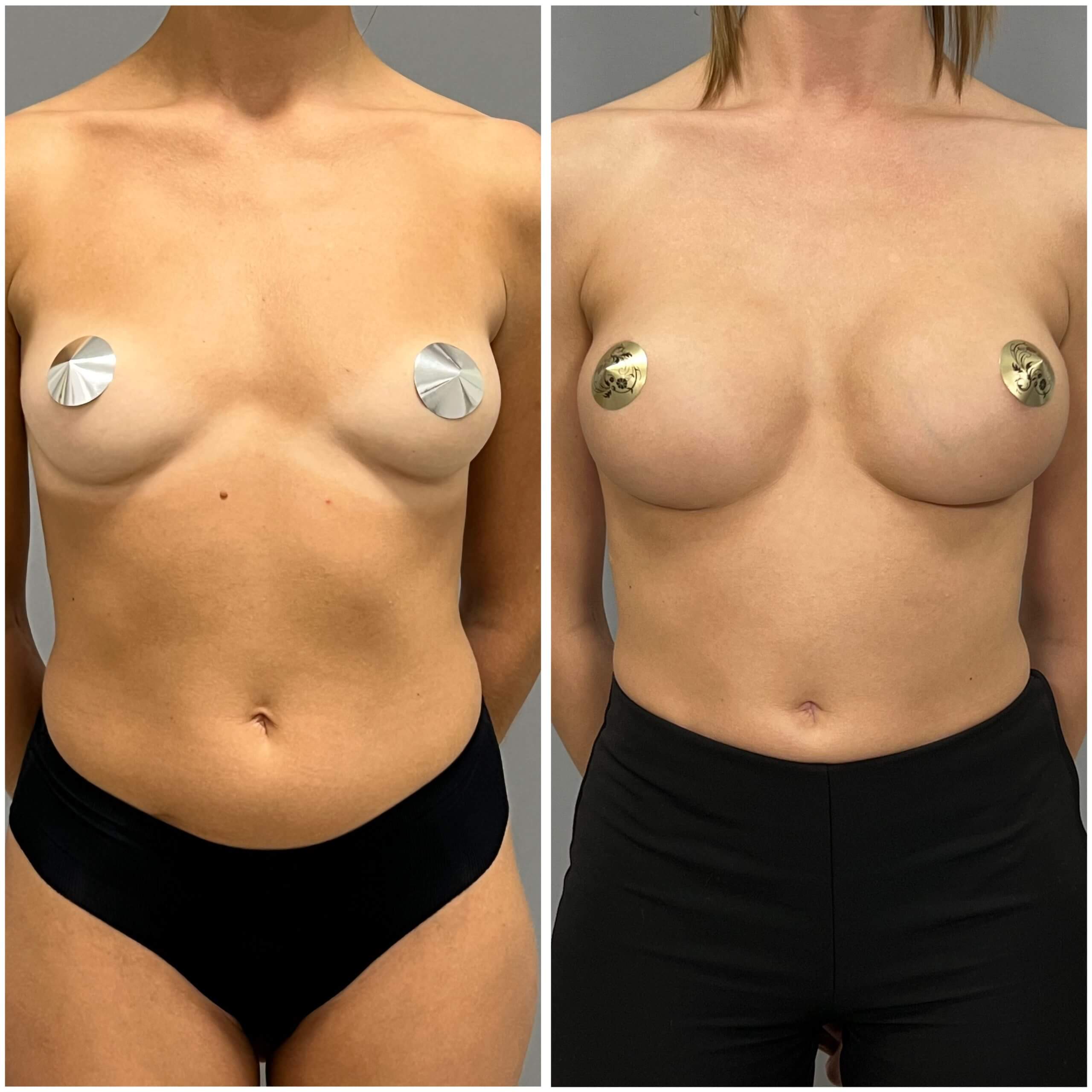 Увеличение груди имплантами 01