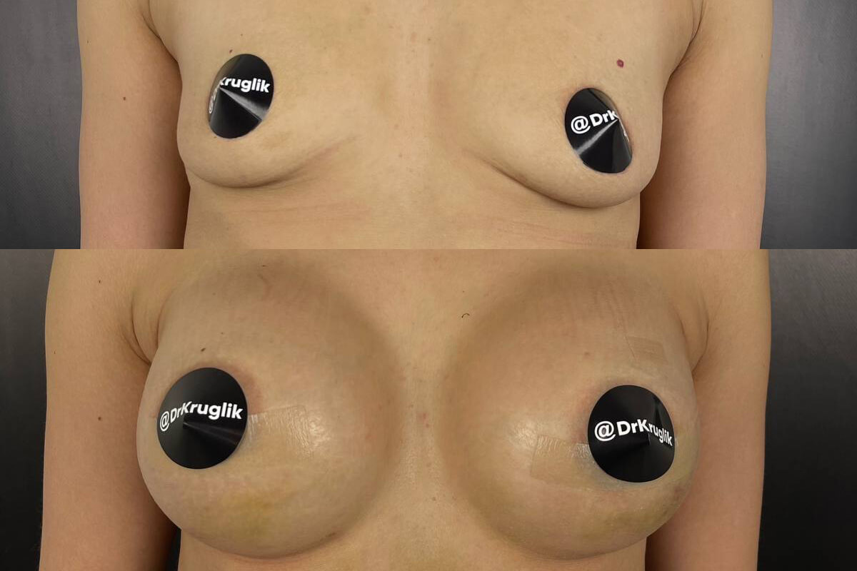 Увеличение груди имплантами 01