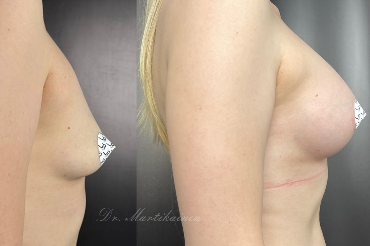 Увеличение груди имплантами 01