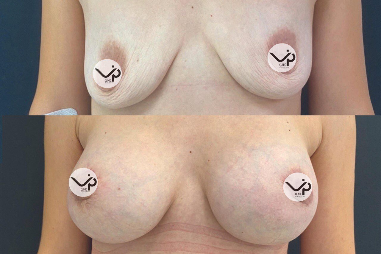 Увеличение груди имплантами 01