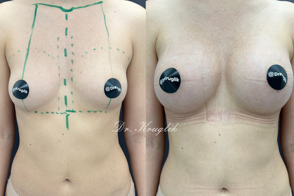 Увеличение груди имплантами 01
