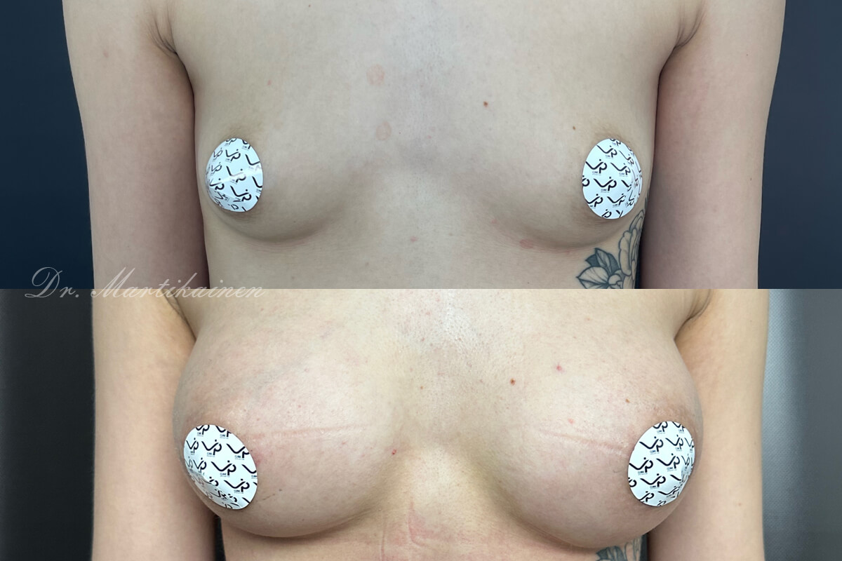 Увеличение груди имплантами 01