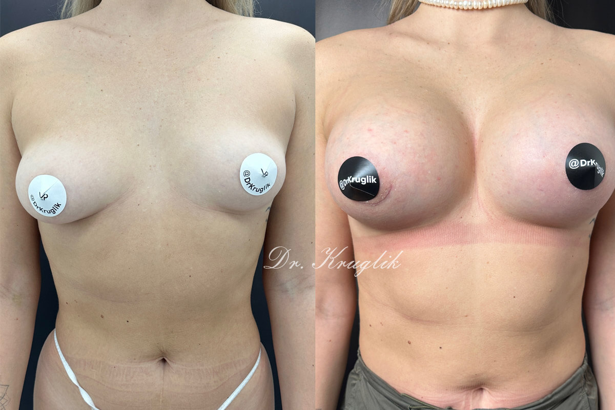 Увеличение груди имплантами 01