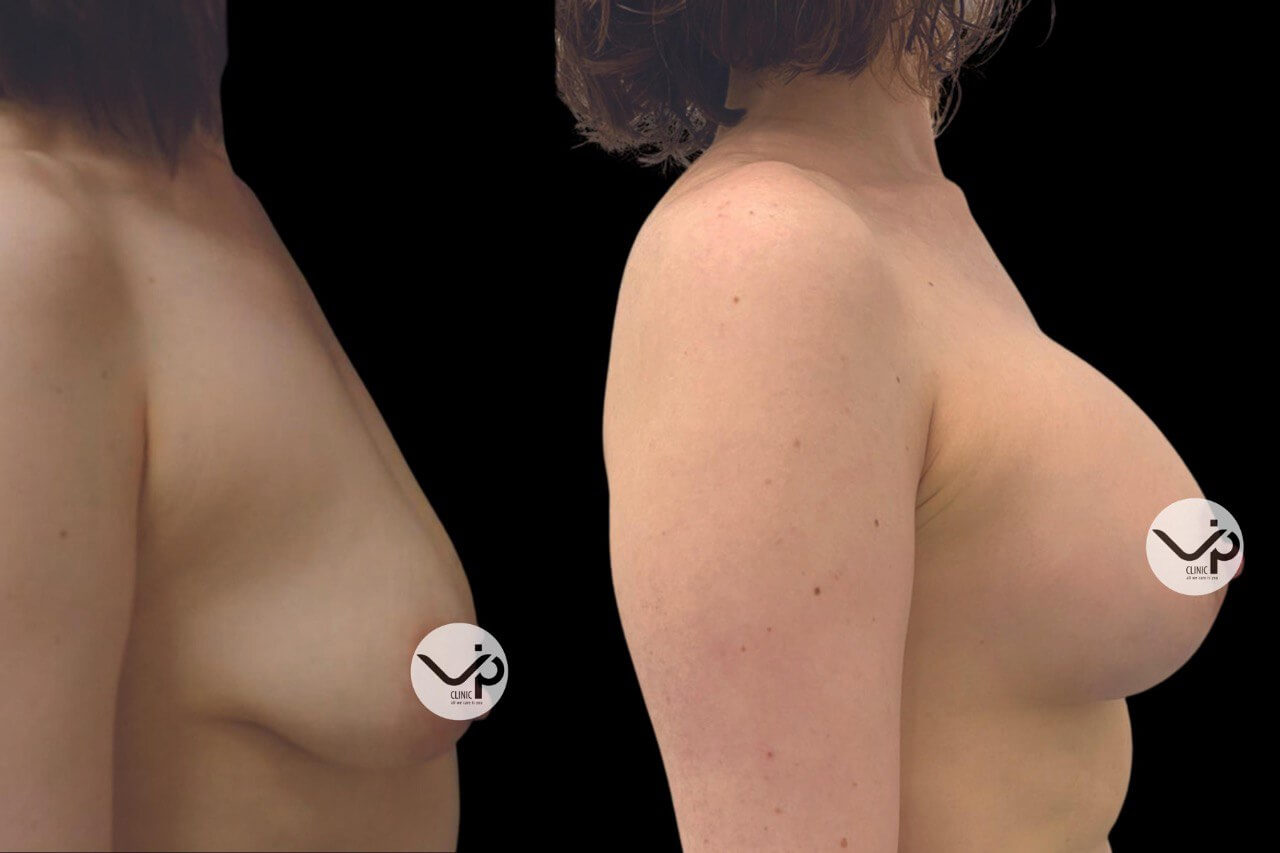 Увеличение груди имплантами 01