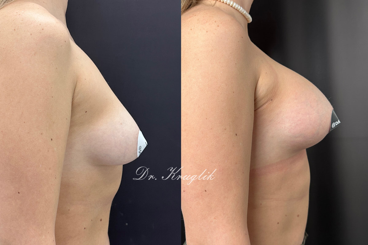 Увеличение груди имплантами 01