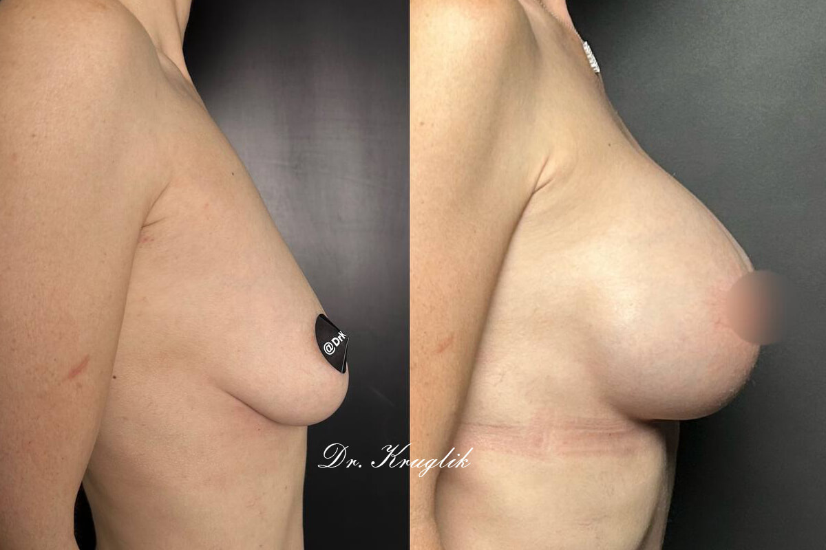 Увеличение груди имплантами 01