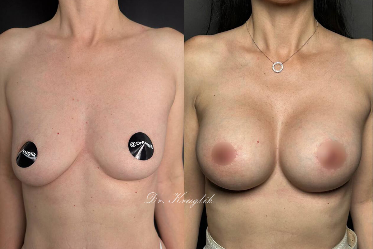 Увеличение груди имплантами 01