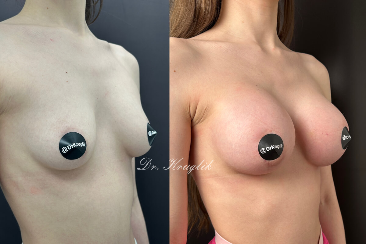 Увеличение груди имплантами 01