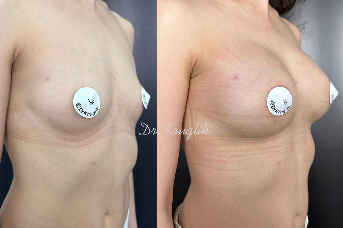 Увеличение груди имплантами 01