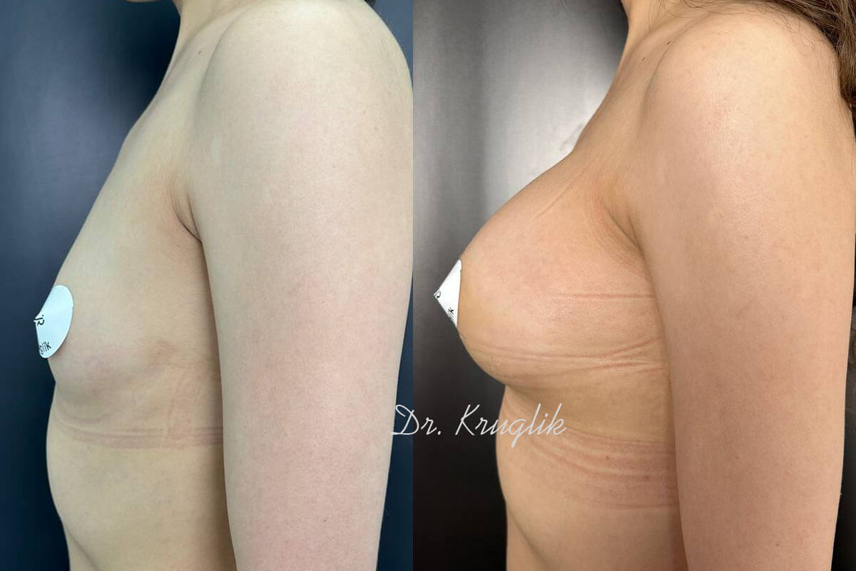 Увеличение груди имплантами 01