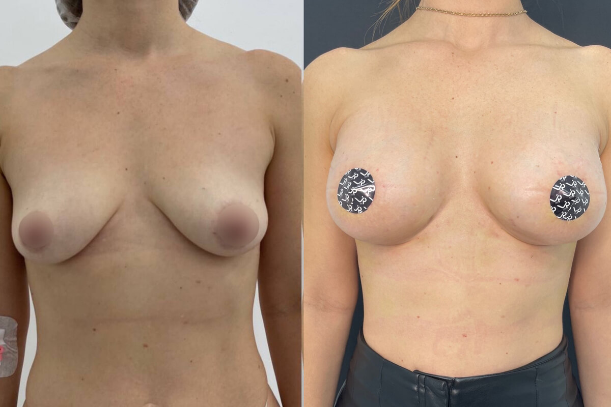 Увеличение груди имплантами 01