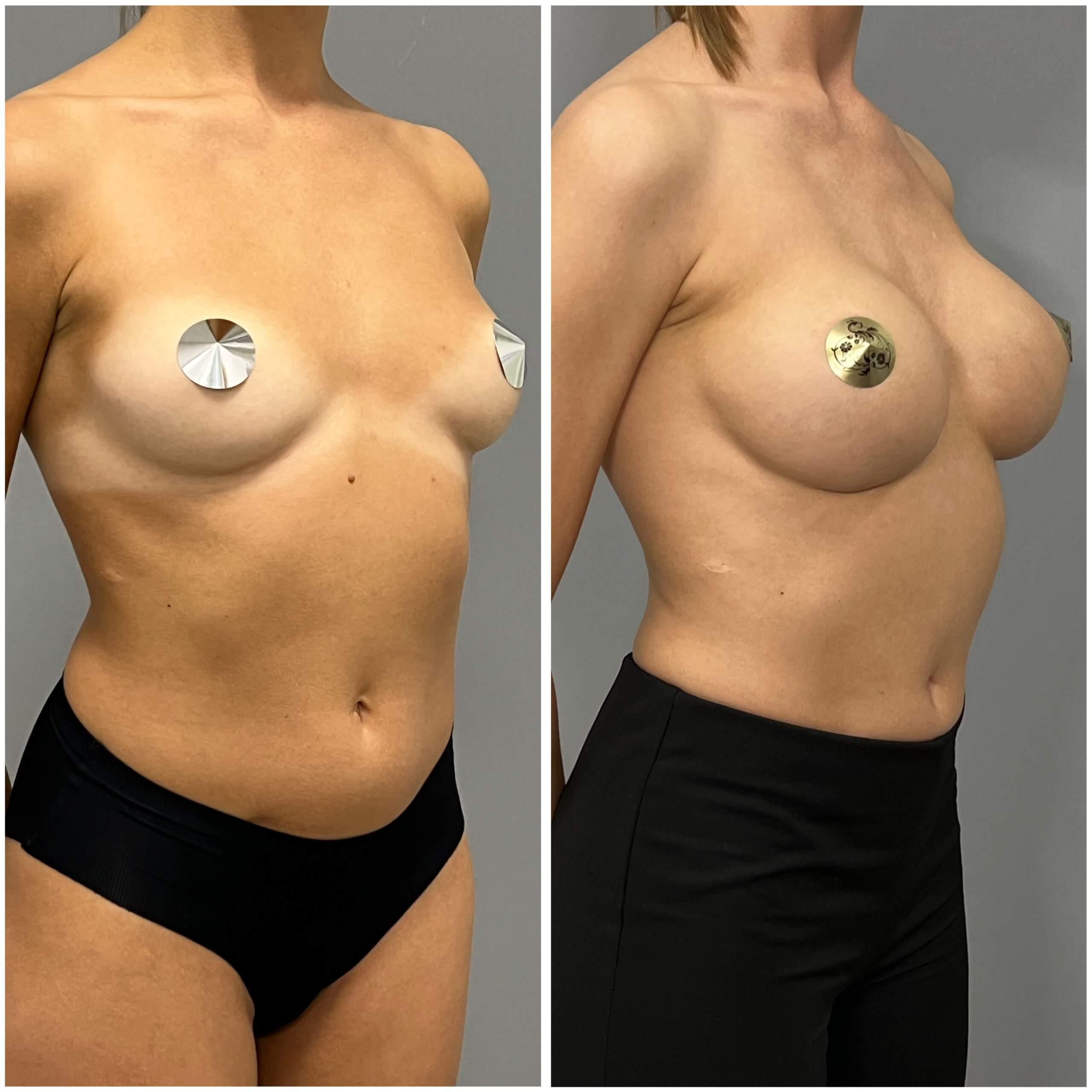 Увеличение груди имплантами 01