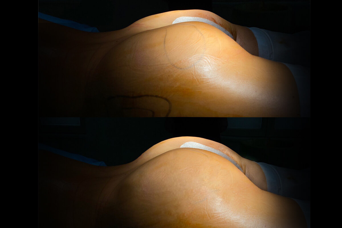 Увеличение ягодиц имплантами 01