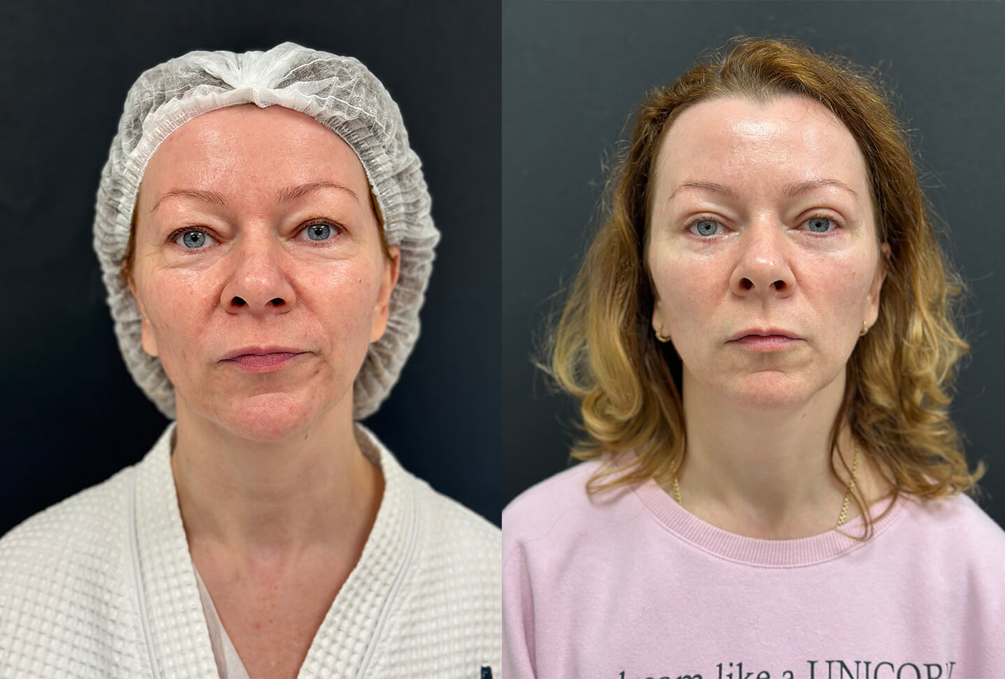 Нижняя блефаропластика 01