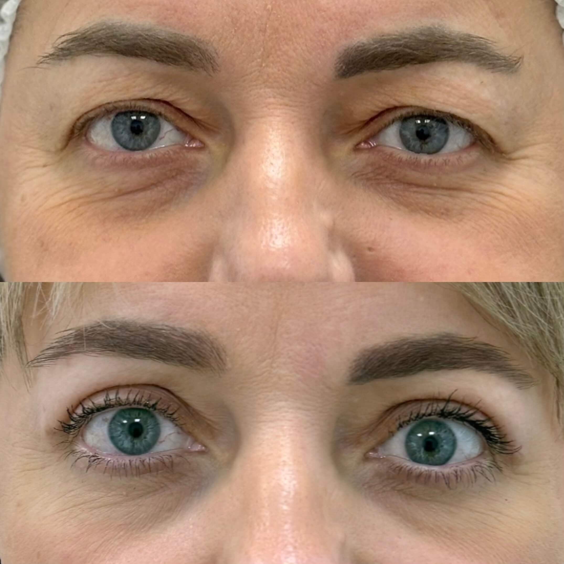 Нижняя блефаропластика 01