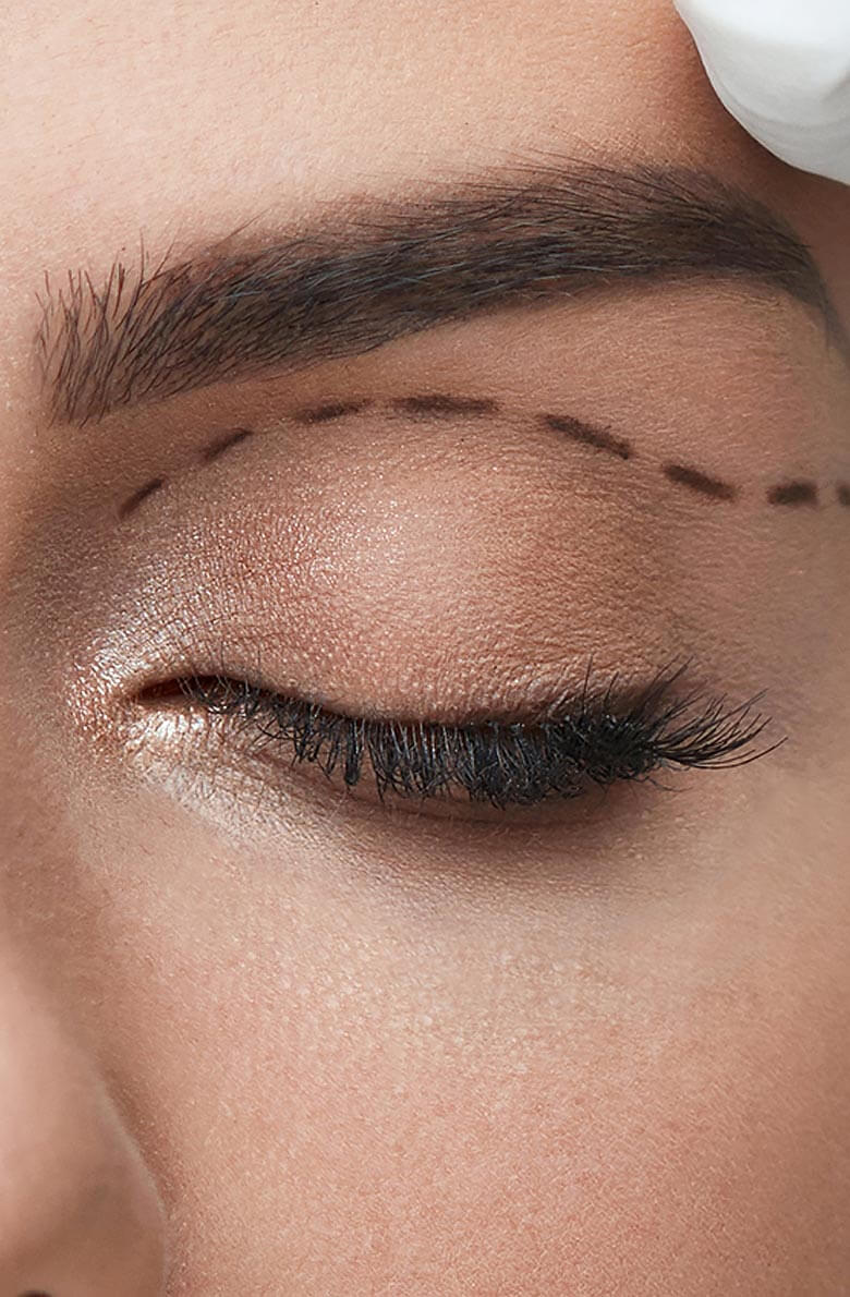 Верхняя блефаропластика