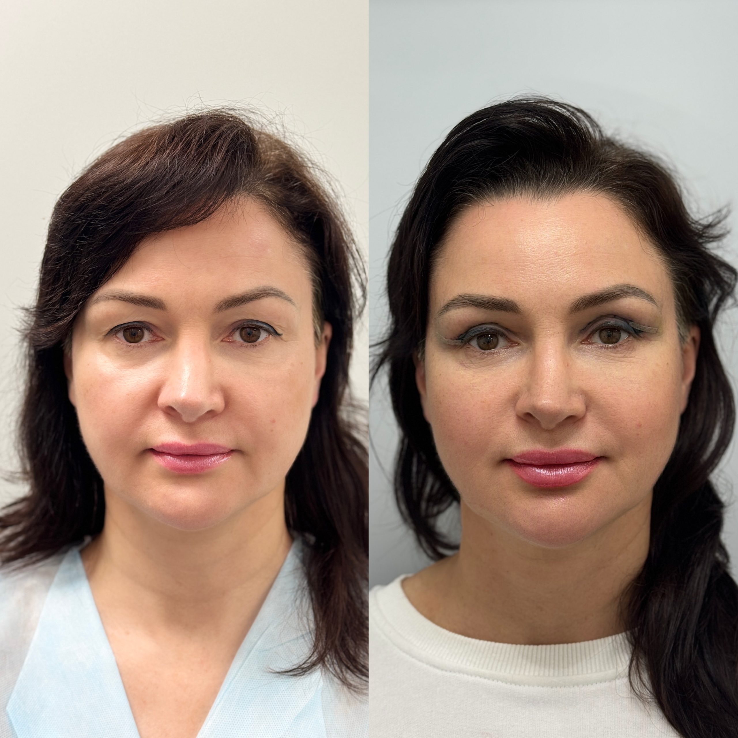 Нижняя блефаропластика 01