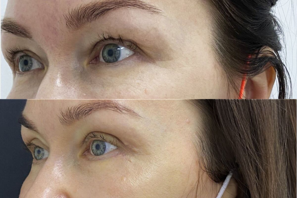 Нижняя блефаропластика 01