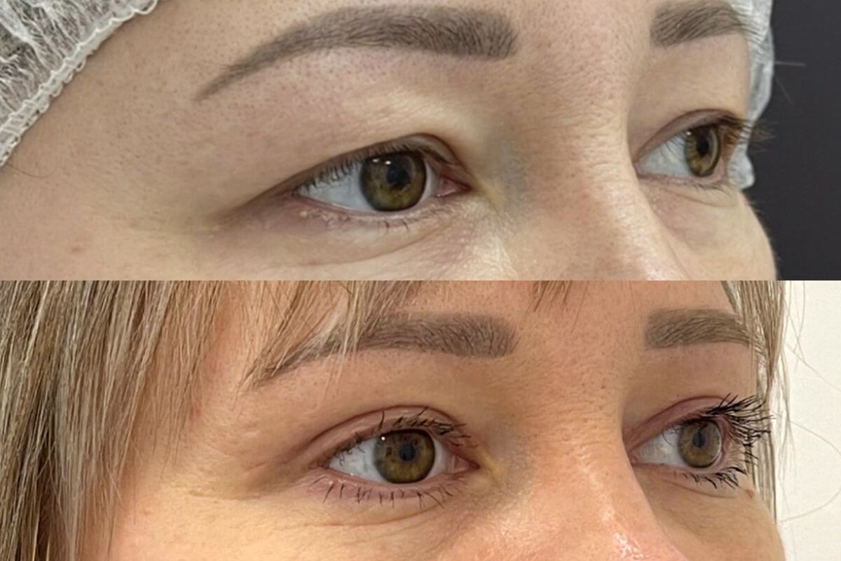 Нижняя блефаропластика 01