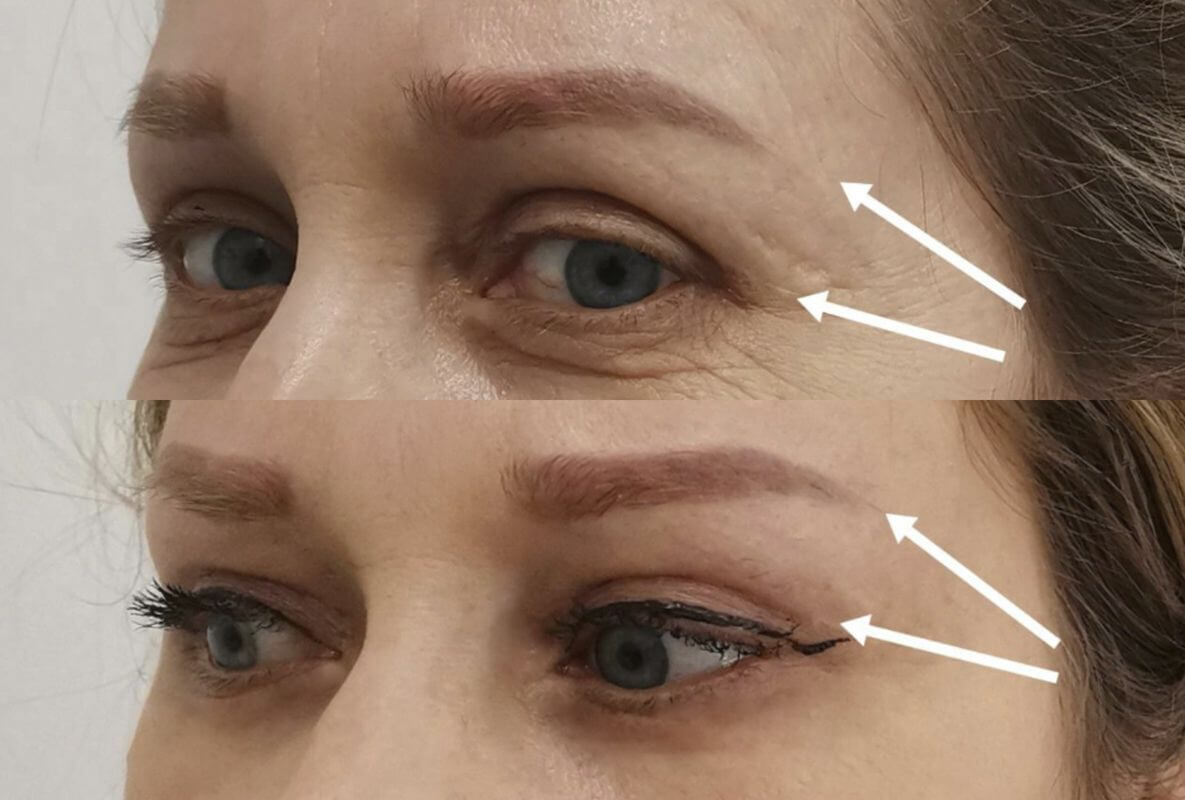 Нижняя блефаропластика 01